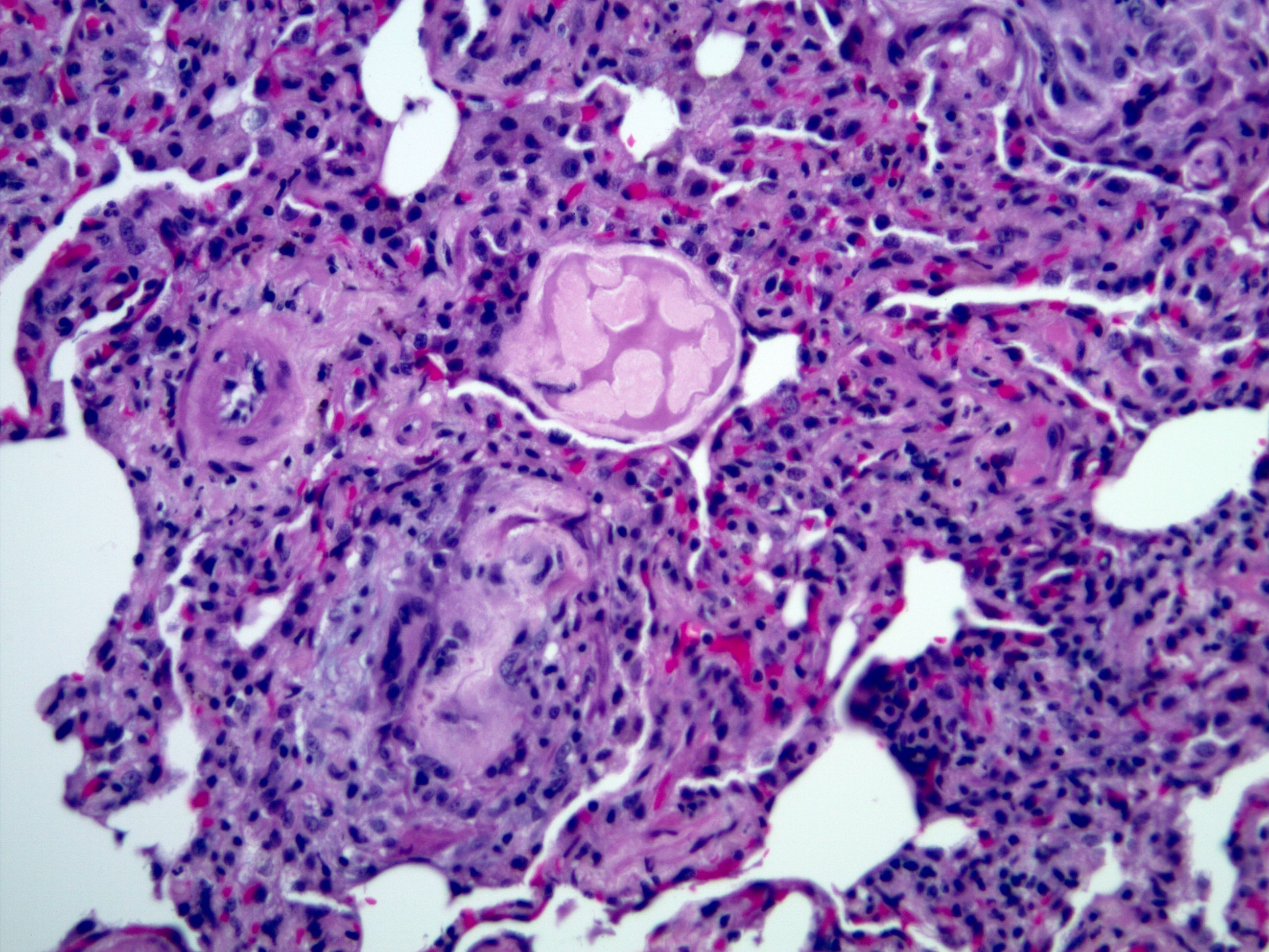 Organizing pneumonia due to aspiration of microscopic food particles